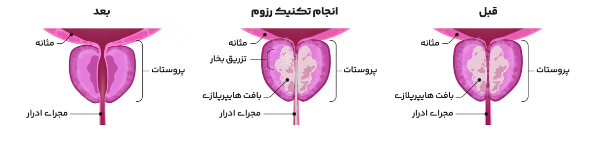 قبل و بعد از درمان پروستات با بخار آب