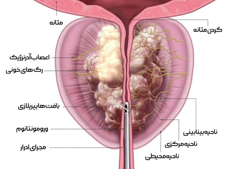 بزرگی پروستات یا هایپرپلازی خوش خیم پروستات