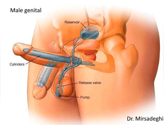 Prosthesis forum penile I had