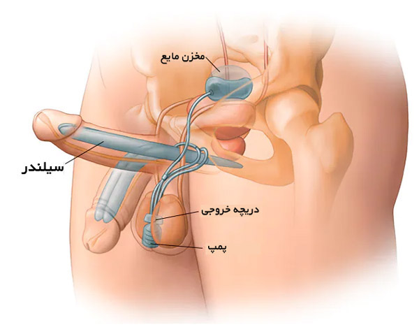 پروتز آلت سه تکه