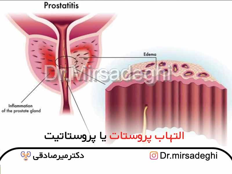 التهاب پروستات (عفونت پروستات) یا پروستاتیت | دکتر میرصادقی
