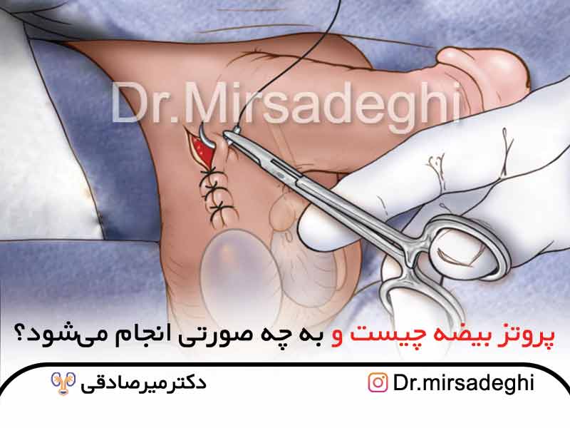 قیمت و خرید پروتز بیضه