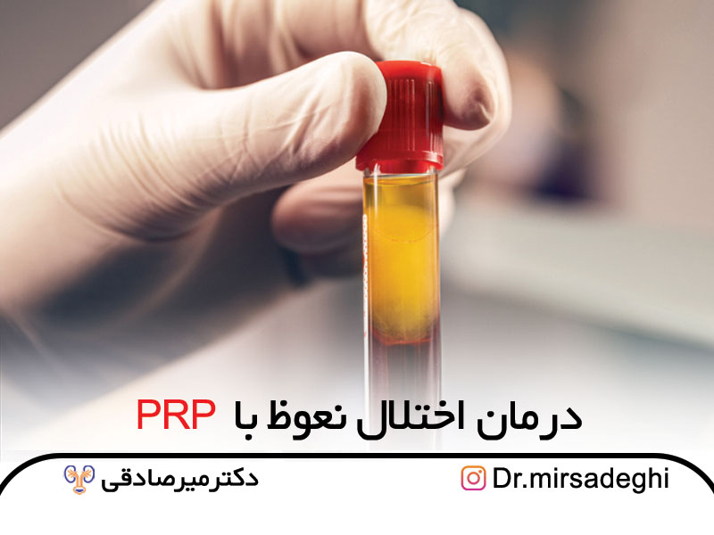 درمان اختلال نعوظ با پی آر پی PRP