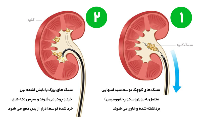 جراحی ریرس RIRS سنگ کلیه