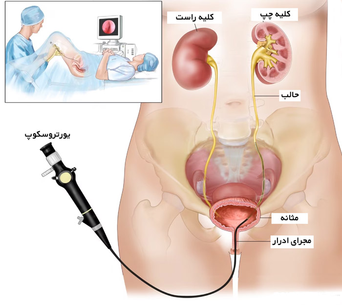 جراحی TUL برای سنگ حالب